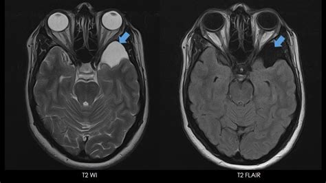 Arachnoid Cyst Imaging .